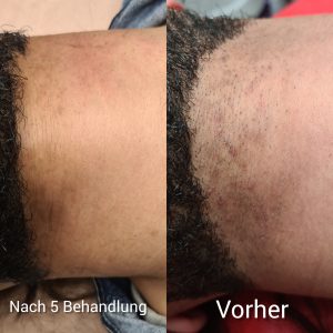 Laser_elegancebeautysalon_1